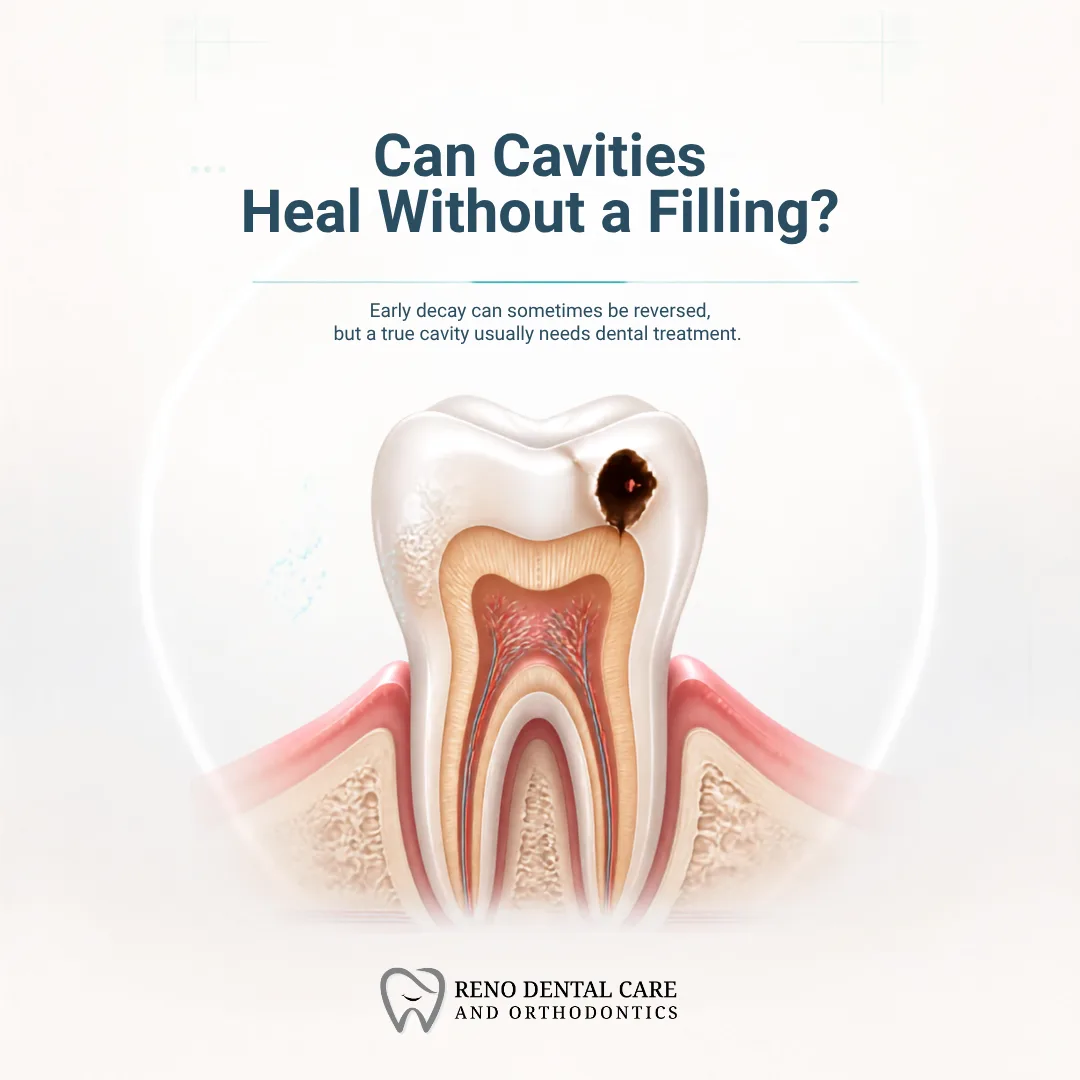 Can Cavities Heal Without a Filling?