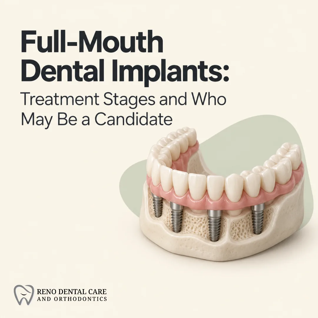Full-Mouth Dental Implants: Treatment Stages and Who May Be a Candidate