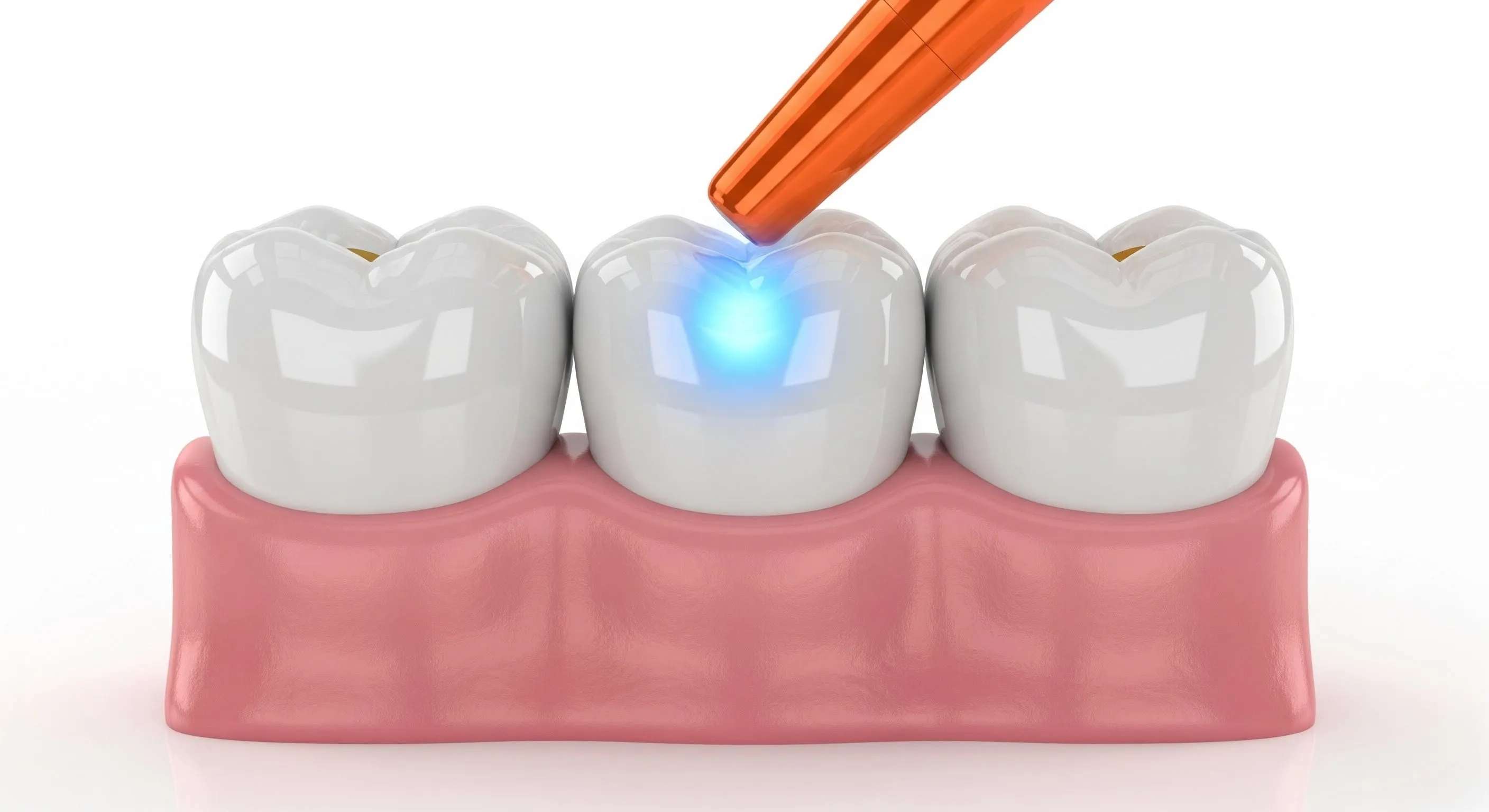 Composite Fillings Cost and Pricing Information in Reno