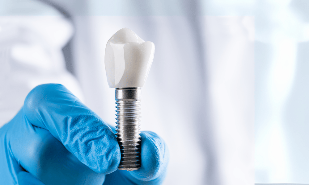 Why Choose Dentist In Reno for Dental Implants?
